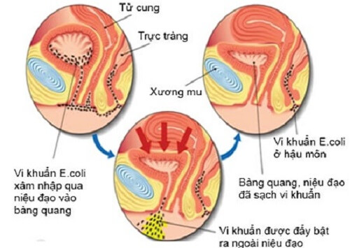 Nhiễm khuẩn đường tiểu